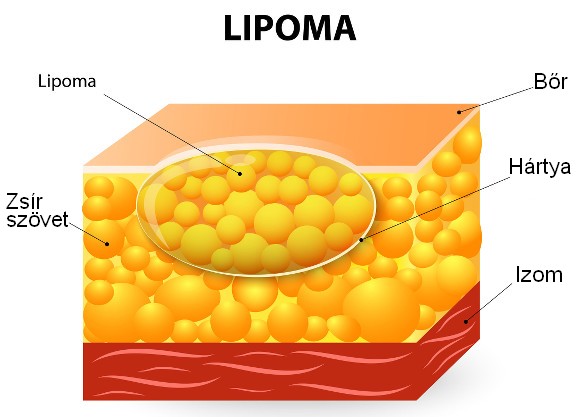 A lipóma (zsírdaganat) - Csomó a testen Térd lipoma kezelés